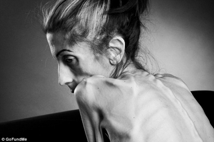 Illustration de l'article : In danger of dying at a weight of just 44 pounds, she takes control and it's impressive to see what she has become...